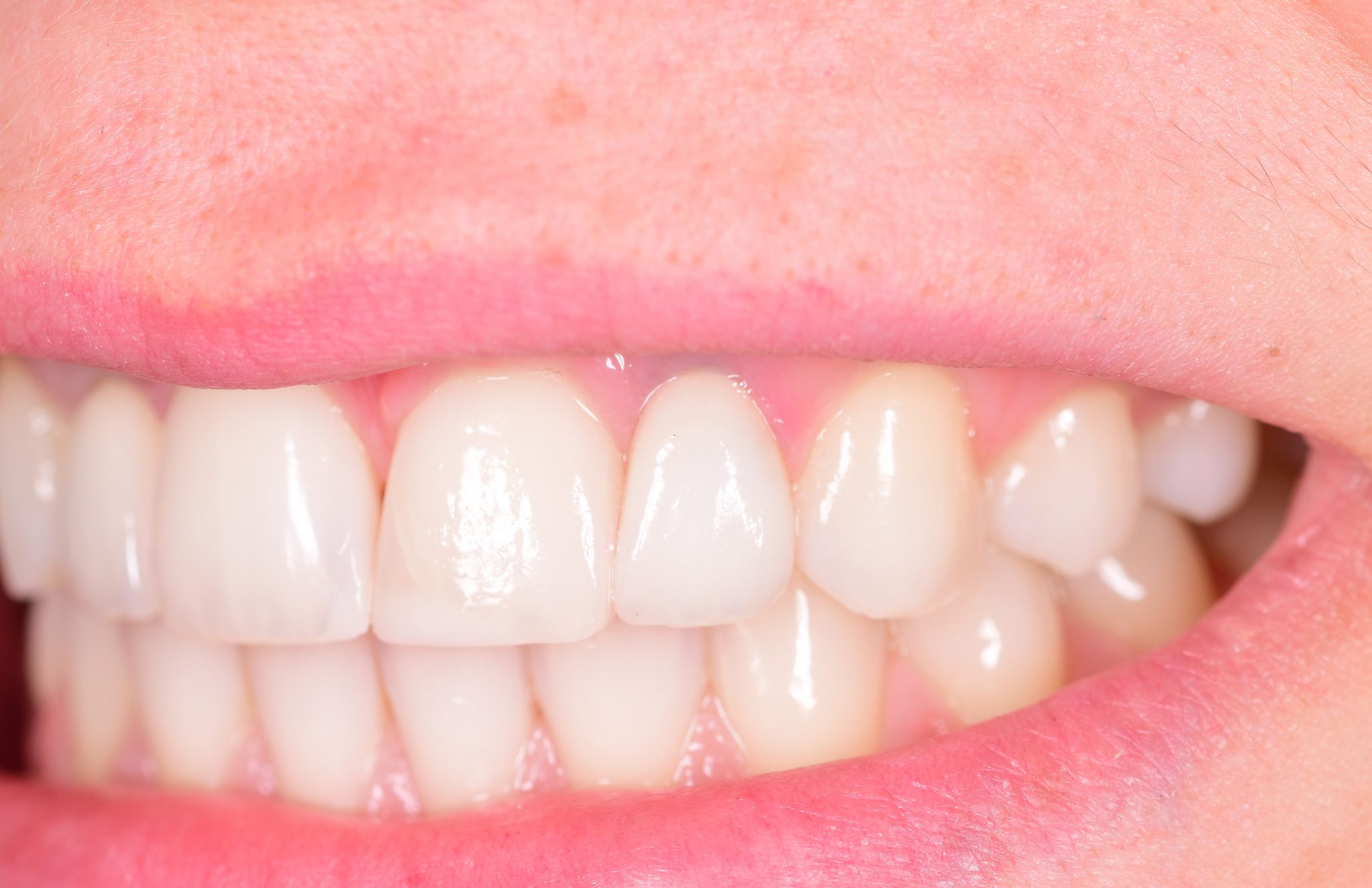 Fate-dentare-2-dupa