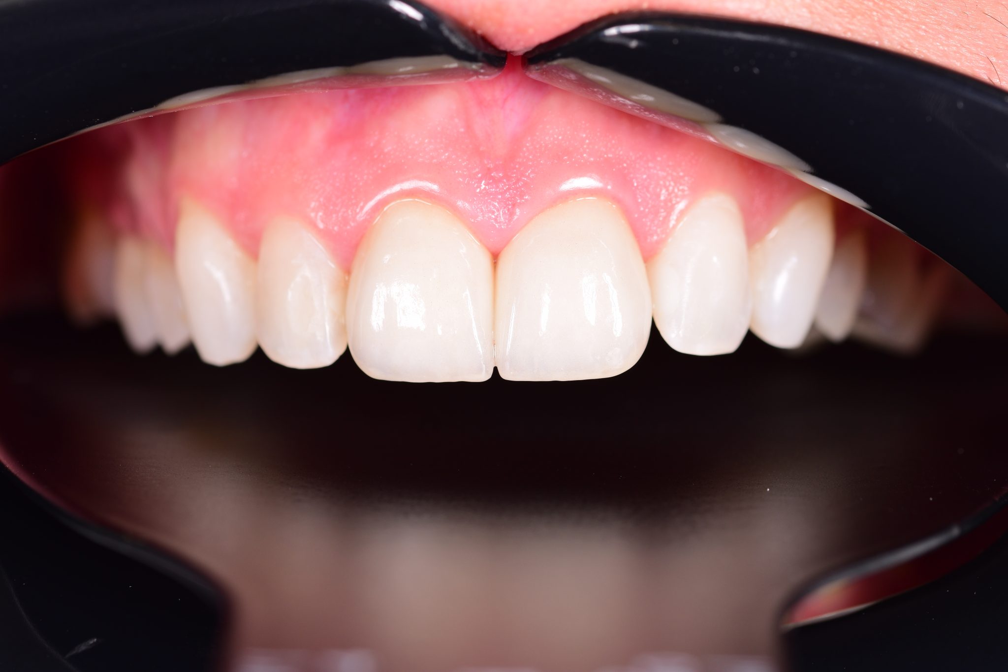 fatete-dentare-dupa